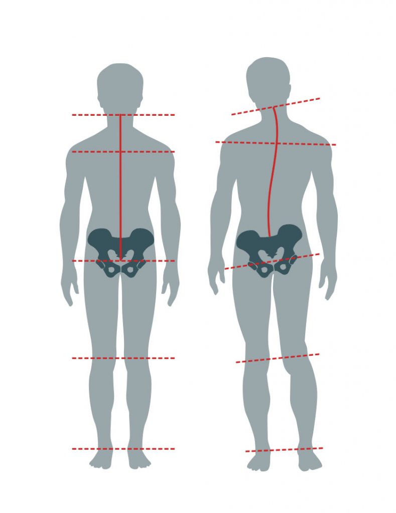 Grafik Gegenüberstellung Unterschiedlich lange Beine